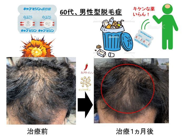 円形脱毛症　病院